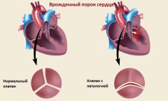 Пороки разного генеза сердца – причины, симптомы, лечение и профилактика